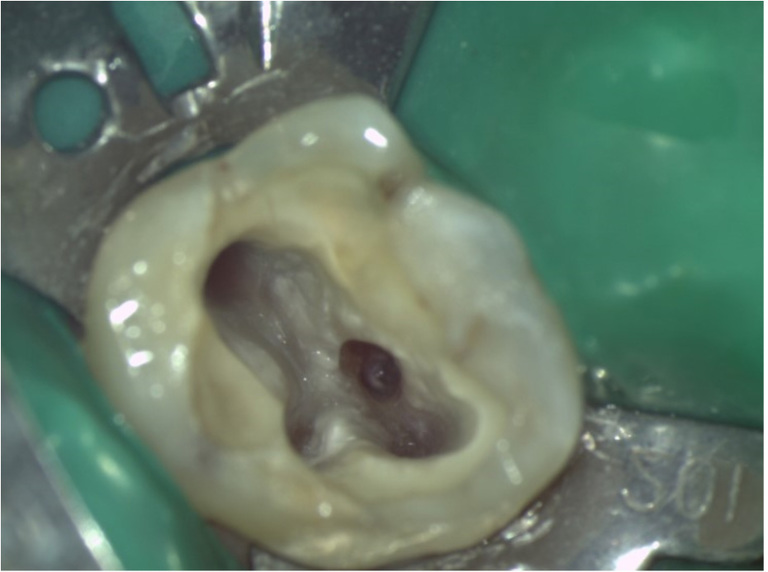 미세현미경 신경치료